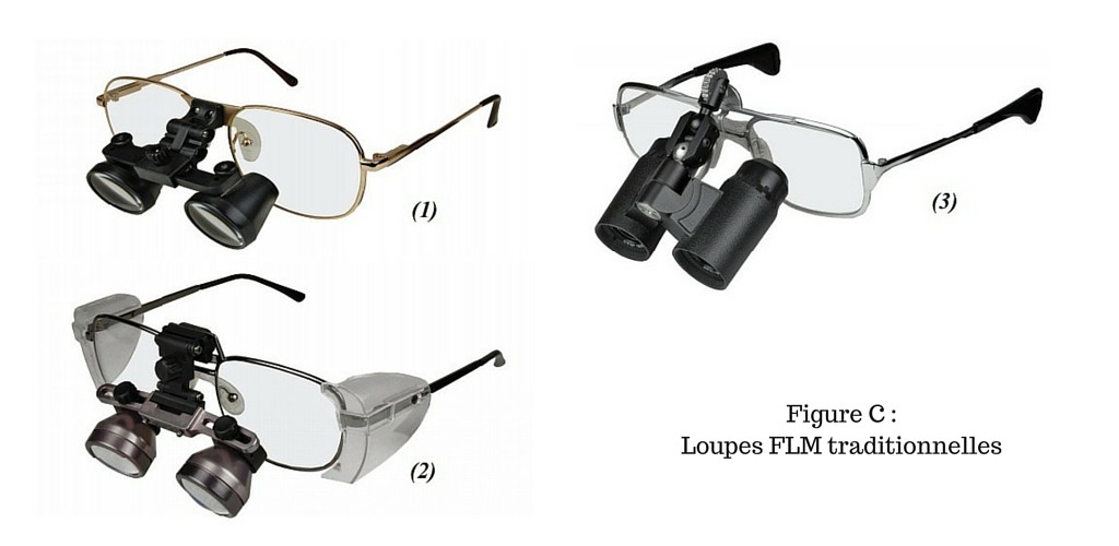 Figure C - Loupes FLM Traditionnelles