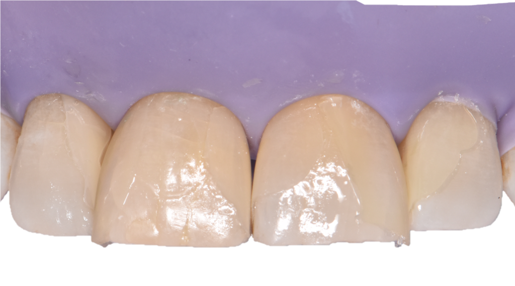 Vue intra-orale après polymérisation des restaurations et retrait des BioClear BT Matrix.