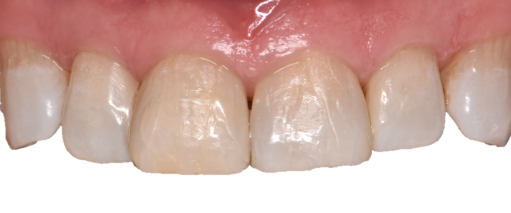 Vue intra-orale immédiate après retrait de la digue, montrant les restaurations des triangles noirs.