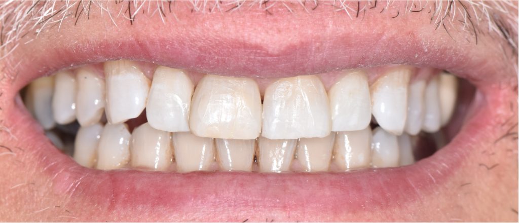 Sourire post-opératoire après fermeture des triangles noirs par restauration adhésive.