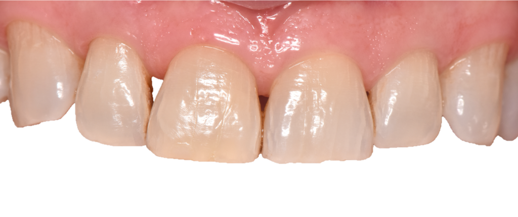 Vue intra-orale pré-opératoire montrant les triangles noirs.