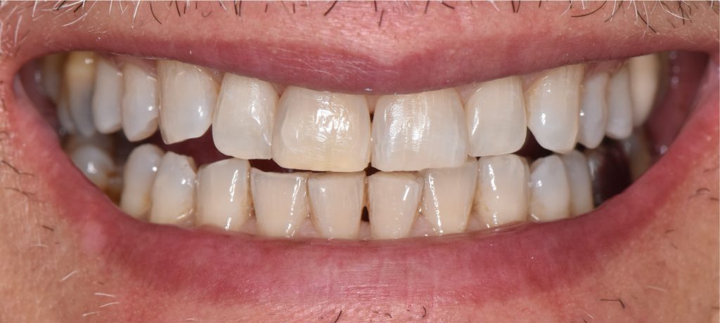 Résultat final : vue clinique du sourire après fermeture des triangles noirs.