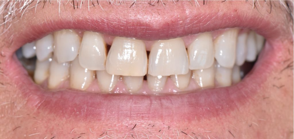 Sourire pré-opératoire montrant la visibilité des triangles noirs.