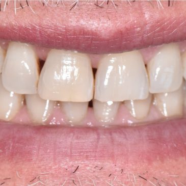 Sourire pré-opératoire montrant la visibilité des triangles noirs.