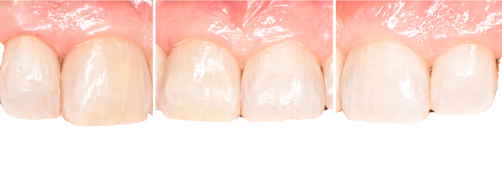 Vue intra-orale une semaine après polissage des restaurations pour fermeture des triangles noirs.