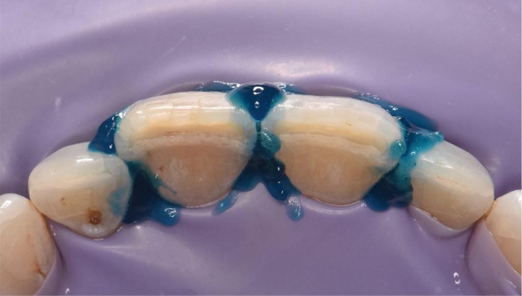Mordançage à l’acide orthophosphorique après nettoyage, polissage et sablage des surfaces dentaires.