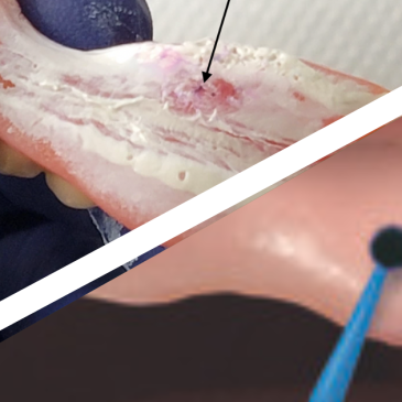 Hydent Sticks et Hydent Spray permettent l'identification précise de lésions ou de points de pression en prothèse adjointe.