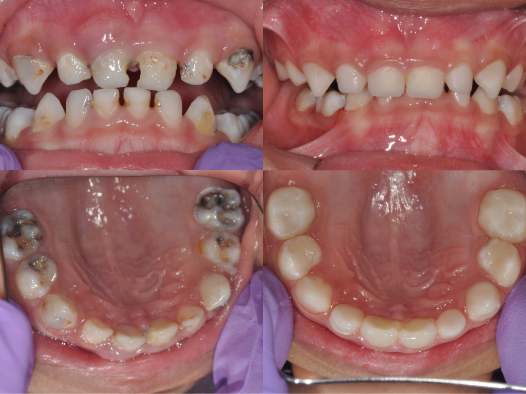 Cas clinique Ceramir Pediatric Crown – restauration esthétique et fonctionnelle chez une enfant de 4 ans.