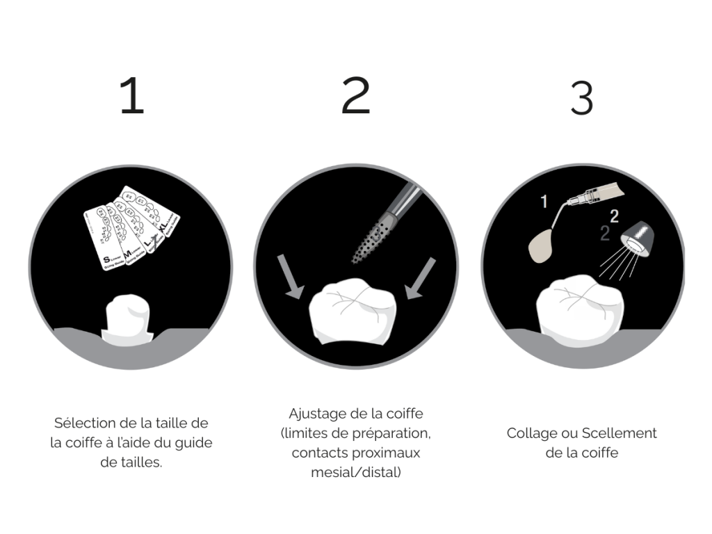 Protocole clinique en trois étapes pour la pose des coiffes Ceramir Pediatric Crown : sélection, ajustage, collage/scellement.